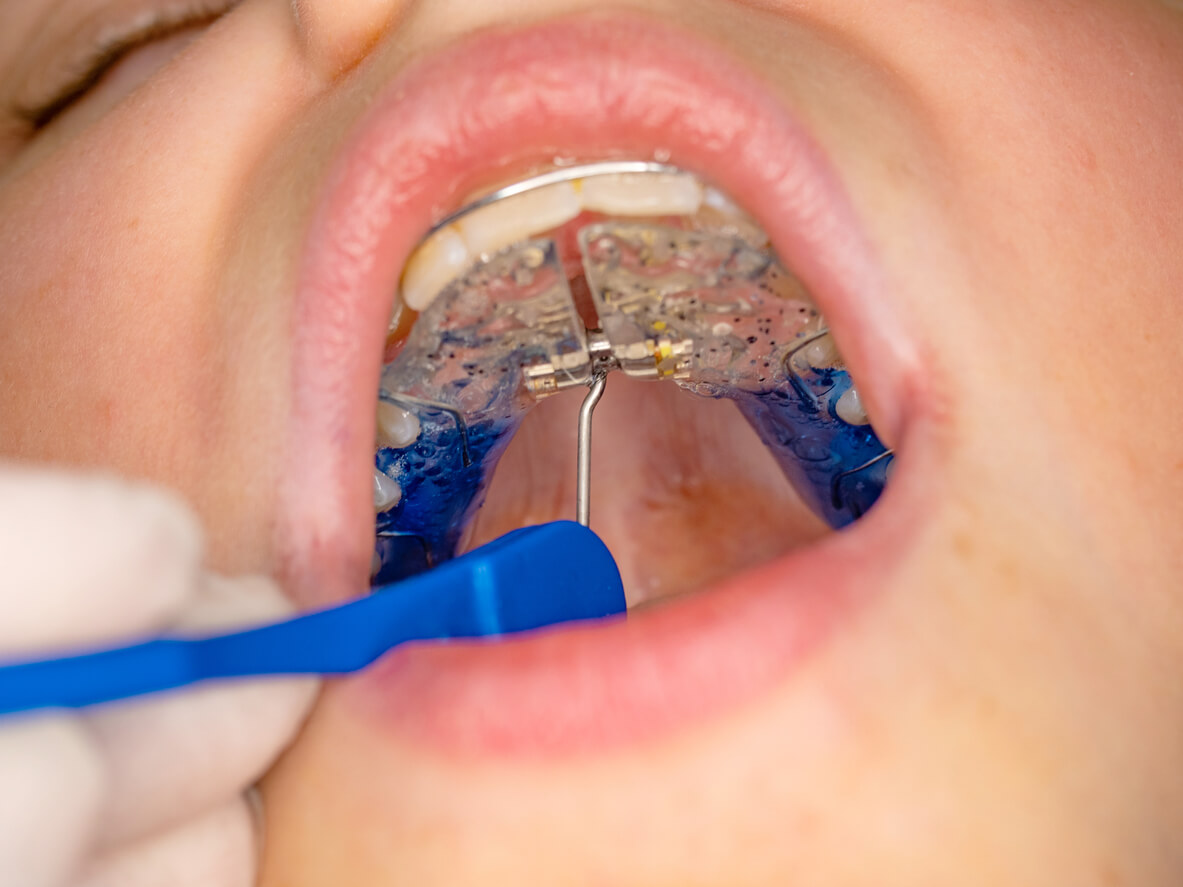 Expansor Palatino — Ortodoncia en Cuenca