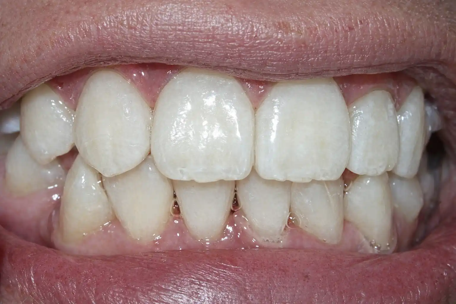 Después de blanqueamiento dental profesional en Ruzbelt Dent Cuenca