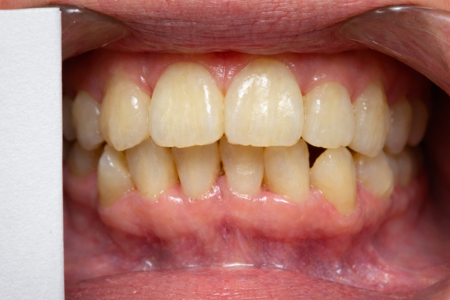 Antes de blanqueamiento dental profesional en Ruzbelt Dent Cuenca
