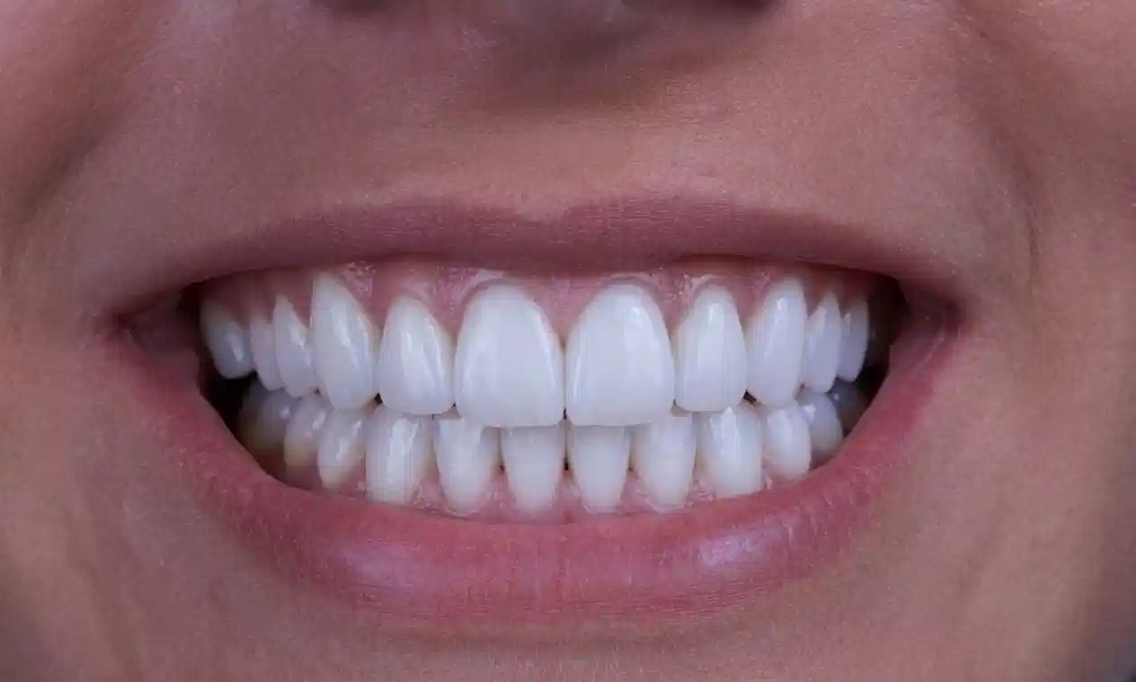 Después de diseño de sonrisa con carillas dentales en Cuenca