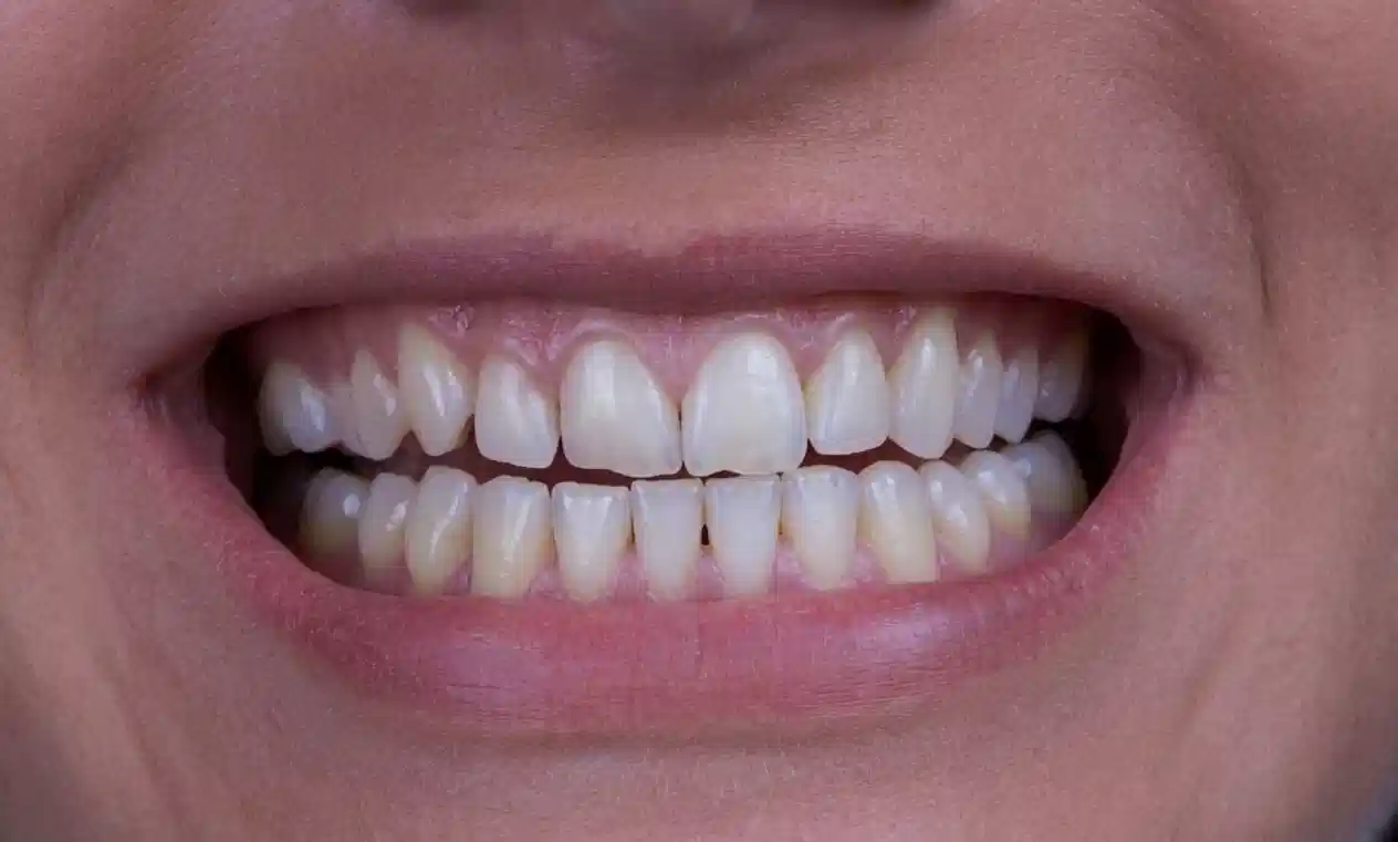 Antes de diseño de sonrisa con carillas dentales en Cuenca