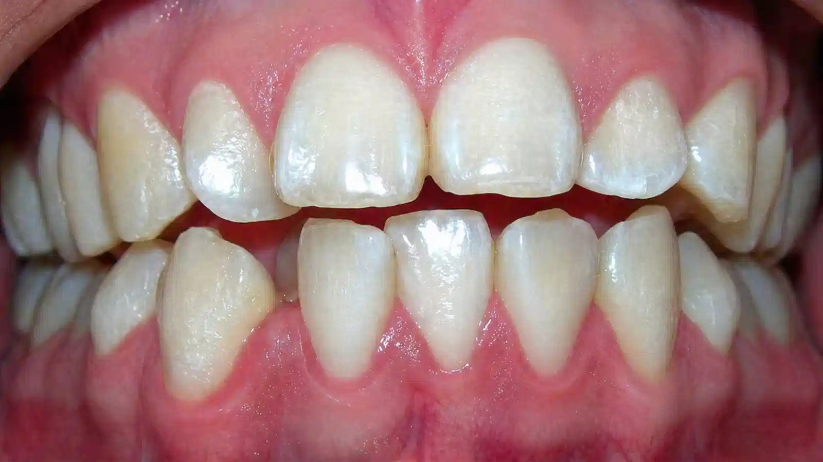Antes de tratamiento de ortodoncia con brackets cerámicos en Cuenca