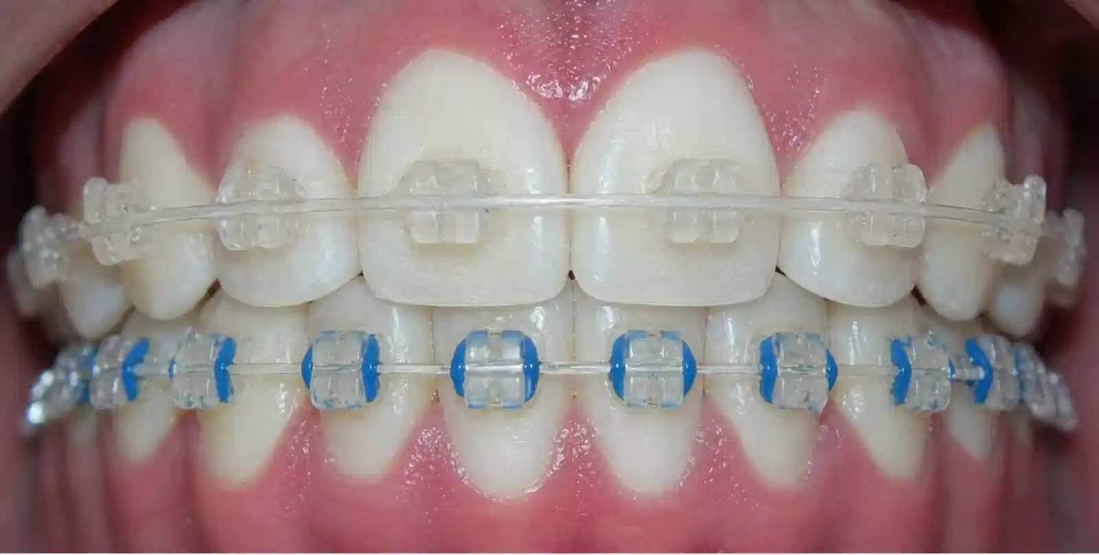 Después de tratamiento de ortodoncia con brackets cerámicos en Cuenca
