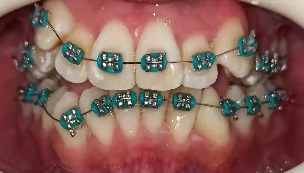 Antes de ortodoncia metálica tradicional en clínica dental Cuenca