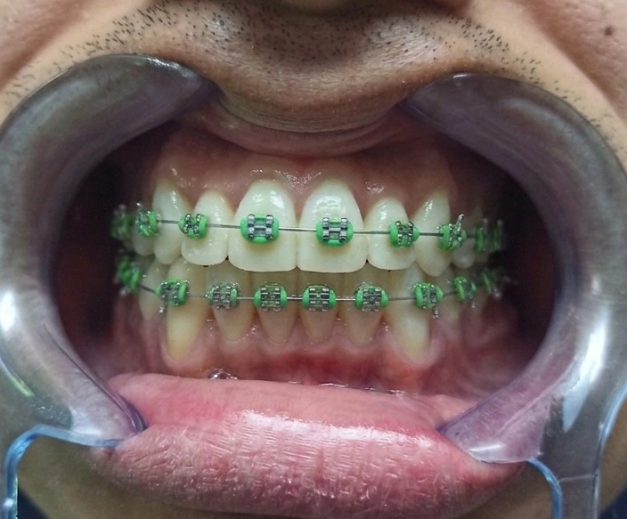 Después de ortodoncia metálica tradicional en clínica dental Cuenca