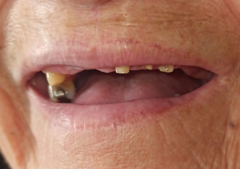 Antes de rehabilitación oral con prótesis dental fija en Cuenca