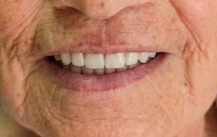 Después de rehabilitación oral con prótesis dental fija en Cuenca